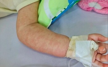 Bùng phát bệnh sởi ở Hà Nội: Đã có ca tử vong, nhiều trẻ chưa tiêm vaccine