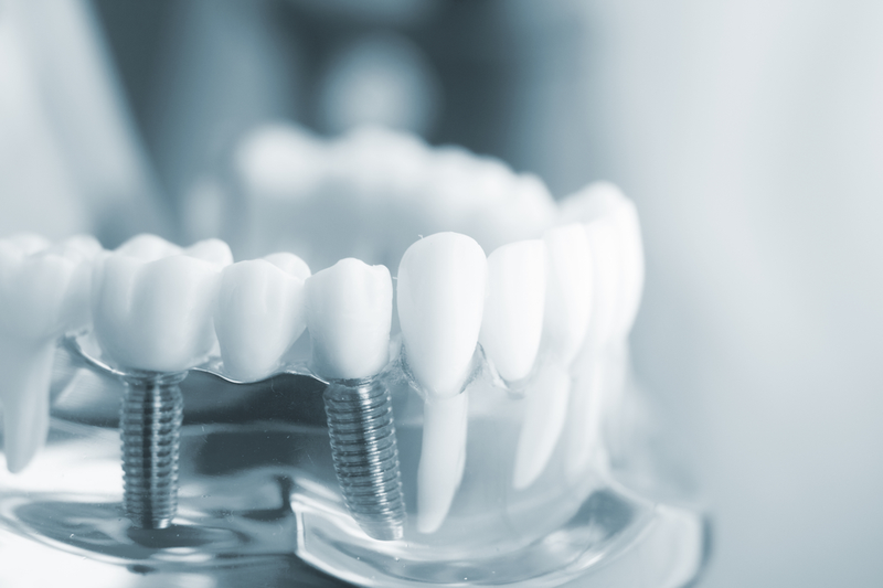 Khó có thể có thời gian chính xác cho một ca implant
